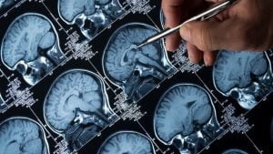 Alzheimer: il test dei soldi che puoi fare anche a casa: identifica in anticipo la malattia Alzheimer: il test dei soldi che puoi fare anche a casa: identifica in anticipo la malattia