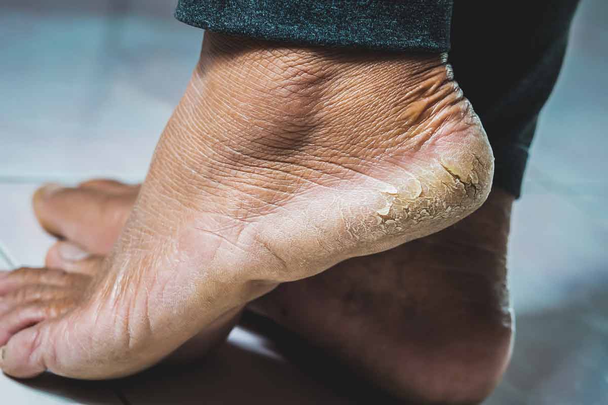 vecteezy primo piano i piedi del tallone sono crepe 7449229